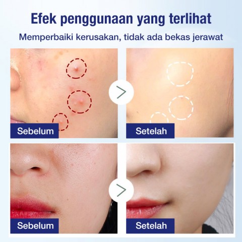 Esensi perawatan kulit anti jerawat Jepang