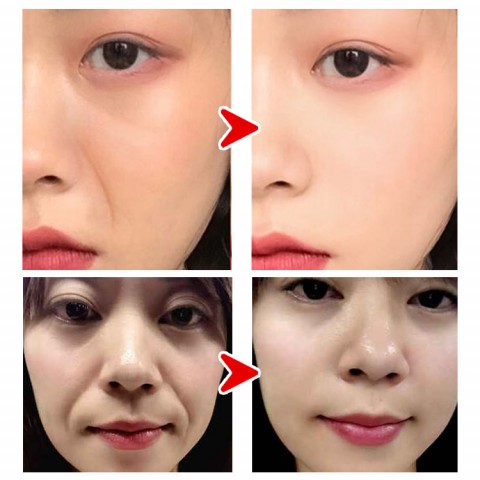 Korean Microcrystalline nasolabial folds anti-wrinkle patch