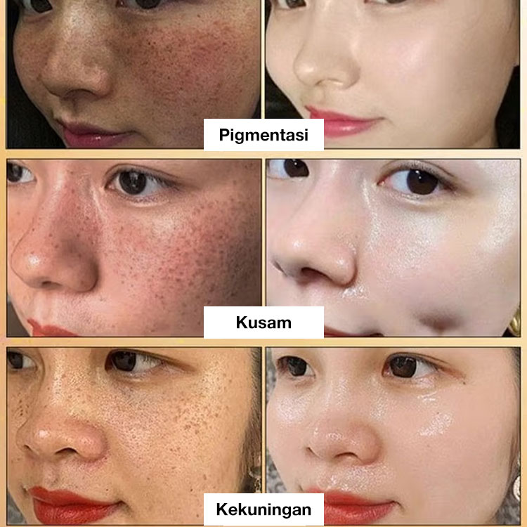 Promo Besar 7.7-Potongan kedua hanya 70 rb - Esensi pencerah spot - Ucapkan selamat tinggal pada semua bintik-bintik, bintik hitam, dan bintik matahari!	